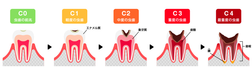 虫歯の進行段階と主な治療法について
